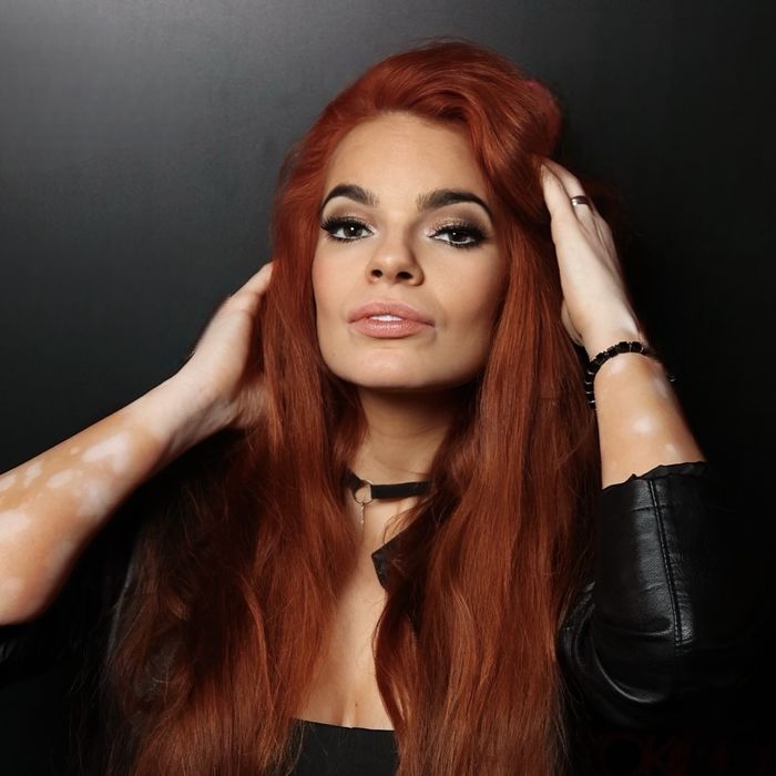 Jana Vitiligo